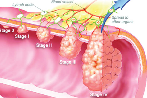 কোলন ক্যান্সার