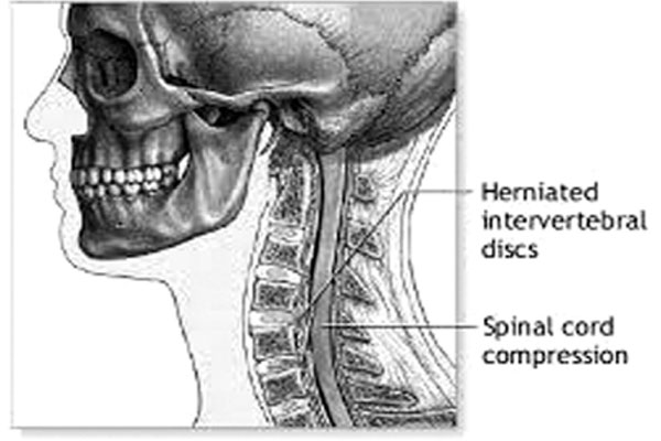 সারভাইক্যাল স্পনডাইলোসিস