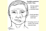 মুখ বেঁকে যাওয়া বা বেলস পলসি