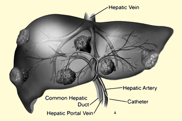 লিভার টিউমার ও ‘টেস’ পদ্ধতি