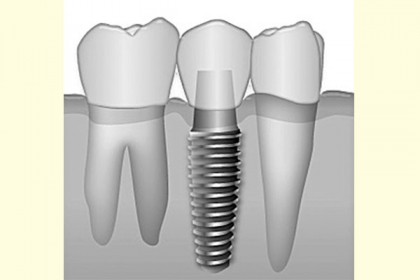 অনুপস্থিত দাঁতের প্রতিস্থাপন