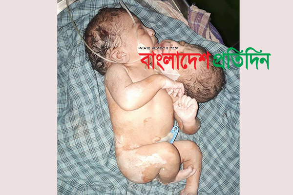 কুমিল্লায় দুই মাথা নিয়ে শিশুর জন্ম
