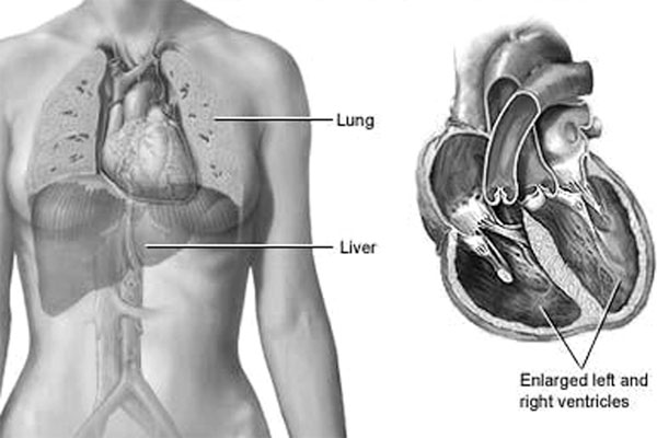 হৃৎপিণ্ড হঠাৎ বড় হয়ে গেলে