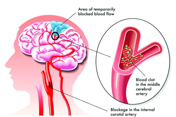 স্ট্রোক কি এবং কেন হয়?