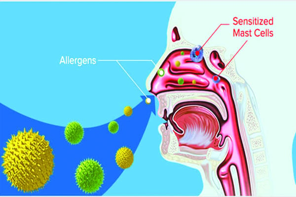 অ্যালার্জিক রাইনাইটিস কী?