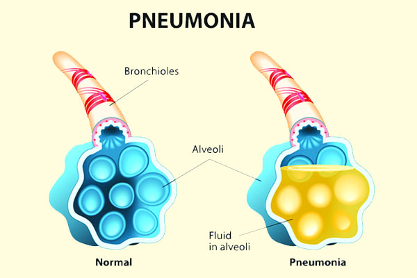 নিউমোনিয়া কখন সারতে চায় না