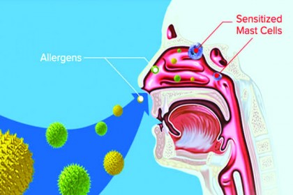 অ্যালার্জিজনিত নাকের সমস্যা