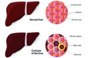 লিভার সিরোসিস কখন হয়