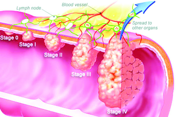 ক্যান্সার যখন বৃহদান্ত্রে