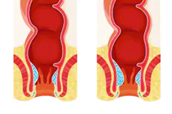 মলদ্বারের রোগে পেটের সমস্যা