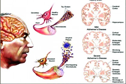 আলঝেইমারস কেন হয়?