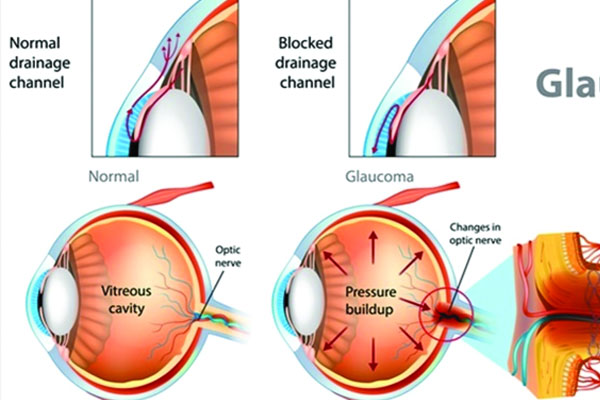 গ্লুকোমা দৃষ্টির সিঁধ কাটা চোর