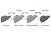 ফ্যাটি লিভারের উপসর্গ ও প্রতিকার
