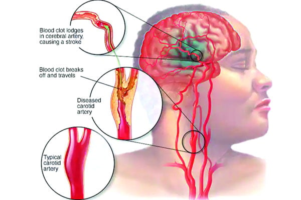স্ট্রোক সম্পর্কিত জরুরি কিছু কথা
