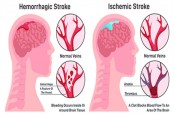 স্ট্রোক নিয়ে কিছু কথা...